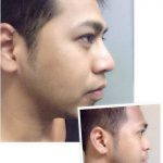 Nose Augmentation Before And After Images (4)