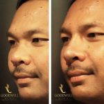 Nose Augmentation For Man Without Surgery