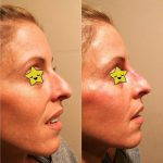Nose Augmentation Procedure Before And After Pictures (1)