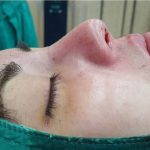 Nose Augmentation Procedure Before And After Pictures (4)