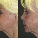 Nose Augmentation Rhinoplasty Before And After (3)