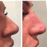 Nose Augmentation Rhinoplasty Before And After (5)