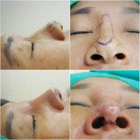Nose Augmentation To Improve The Appearance Of A Flattened Nose