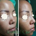 Nose Augmentation With Fillers Photos