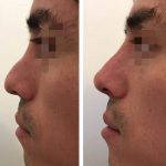 Nose Bridge Augmentation For Man (3)