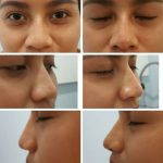 Nose Bridge Augmentation With Fillers