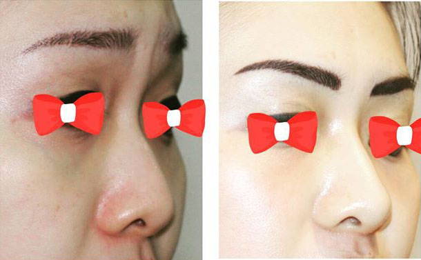 Nose Bridge Surgery After And Before » Rhinoplasty: Cost, Pics, Reviews ...