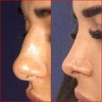 Nose Job Can Improve Features In Your Current Nose That Detract From Your Overall Facial Aesthetics