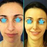 Nose Job For Bulbous Nose Is To Create A Natural And More Attractive Nose