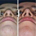 Nose Job For Bulbous Tip Creates Attractiveness Of An Otherwise Beautiful Face