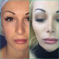 Nose Job Is One Of The Most Popular Cosmetic Surgery Procedures