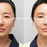 Nose Plastic Surgery Procedure In