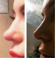 Nose Surgery Procedure At Chevy Chase Facial Plastic Surgery