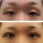 Nose Tissue Augmentation Before And After