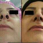 Nose plastic surgery to Reduce the size of the nostrils