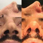 One Of The Most Difficult Things To Do During A Rhinoplasty Is To Straighten A Crooked Nose