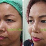 Open Nose Surgery For ASian Nose