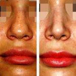 Open Rhinoplasty Nose Tip Surgery