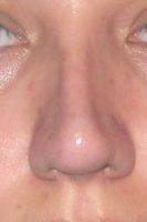 Perfect Nose Tip In Tijuana Mexico by Dr. Manuel Gutierrez Romero