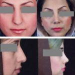 Persian Rhinoplasty Before After (3)