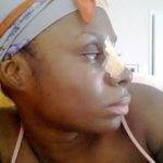 Photo Of Rhinoplasty For African American Nose