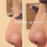 Photos Of Asian Non Surgical Nose Job Before And After
