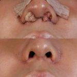 Pic Of Rhinoplasty For Bulbous Nose