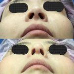 Picture Of Korean Nose Tip Refinement