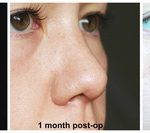 Pictures Of Bulbous Nose Tip Reshaping