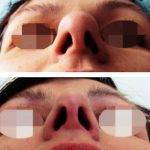 Plastic Surgery For Bulbous Nose
