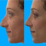 Plastic Surgery For Nose Simulator