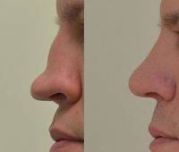 Plastic Surgery For Nose The Best Way To Augment The Bridge