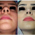 Plastic surgery to Reduce the nasal width
