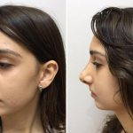 Plastic surgery to improve the shape of your nose