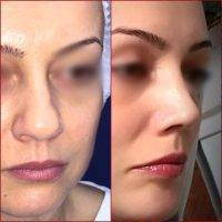 Procedure Of Rhinoplasty In Gold Coast Before And After Results