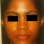 Revision African American Rhinoplasty Is Usually Performed Using An Open Technique, Allowing For Greater Visualization Of The Nasal Cavity