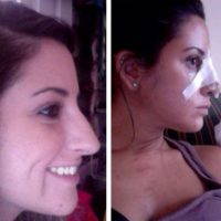 Rhinoplasty Aftercare Tips