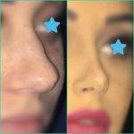 Rhinoplasty Before And After Bulbous