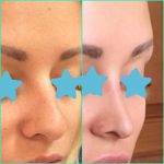 Rhinoplasty Big Nose Prices In