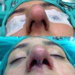 Rhinoplasty Bulbous Nose Before And After