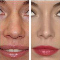 Rhinoplasty Bulbous Nose Reduction Is One Of The Most Commonly Requested Changes That Patients Bring Up