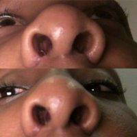 Rhinoplasty For Black Bulbous Nose