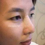 Rhinoplasty Is Perhaps The Most Coveted Surgery In South Korea