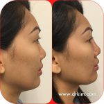 Rhinoplasty Nose Job Before And After Asian Women