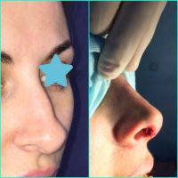 Rhinoplasty Patients Should Have Realistic Expectations For Improvement