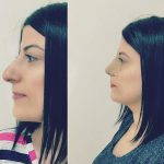Rhinoplasty Roman Nose Before And After (2)