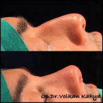 Rhinoplasty Roman Nose Before And After (3)
