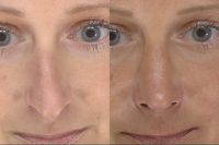 Rhinoplasty Simulation Software Is Used To Make Changes On Your Picture Before Cosmetic Surgeries
