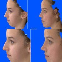 Rhinoplasty Simulator Online To Predict What The Outcome Of Surgery Would Look Like