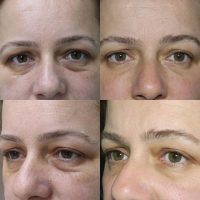 Rhinoplasty Surgery Can Change The Shape Of The Whole Nose Or Of Just A Small Part